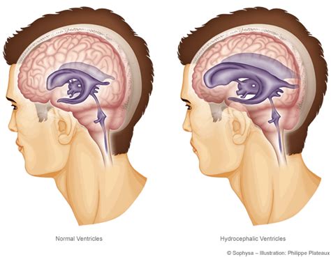 Hydrocephalus Disease Symptoms, Causes and Treatments | Adult ...