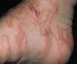 Human Hookworm | Israel| PDF | PPT| Case Reports | Symptoms | Treatment