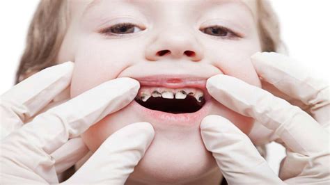 Kid’s multiple dental cavities treatment (full mouth rehabilitation)