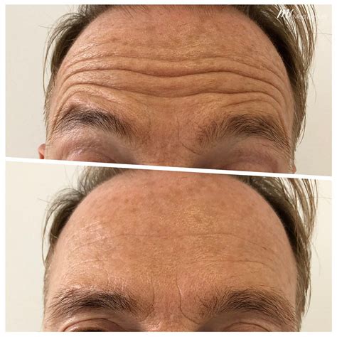 Anti-wrinkle injection treatments – M1 Med Beauty Australia