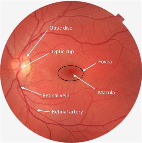 Fundoscopic Exam Abnormal Findings