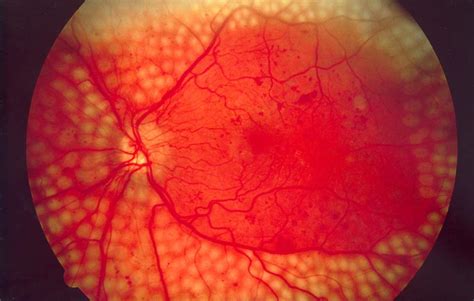 Diabetic retinopathy - Wikipedia