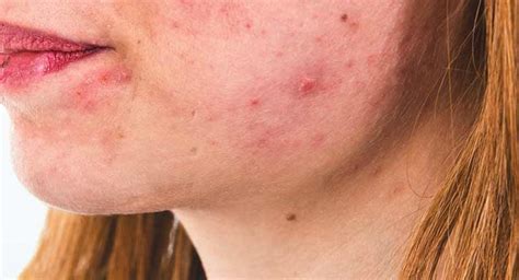 Accutane Side Effects: What Are They?