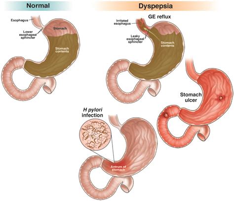 Dyspepsia - AGA GI Patient Center