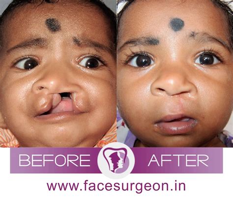 Cleft Palate Repair Post Op