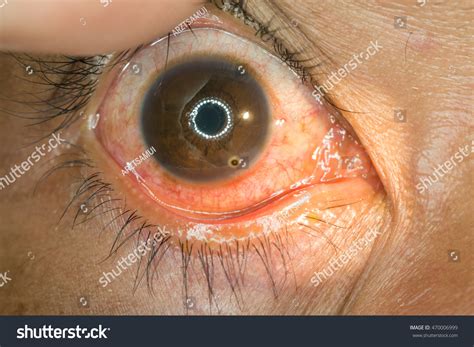 Close Corneal Metallic Foreign Body Right Stock Photo 470006999 ...