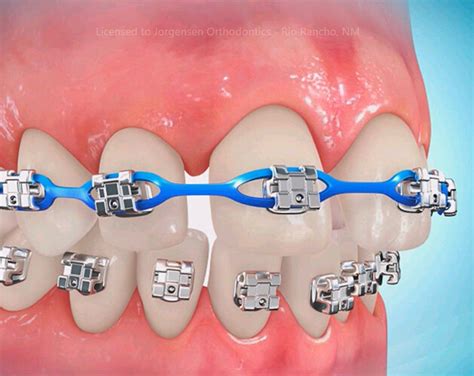 how do braces work for gaps - Has A Nice Ring Blogs Pictures