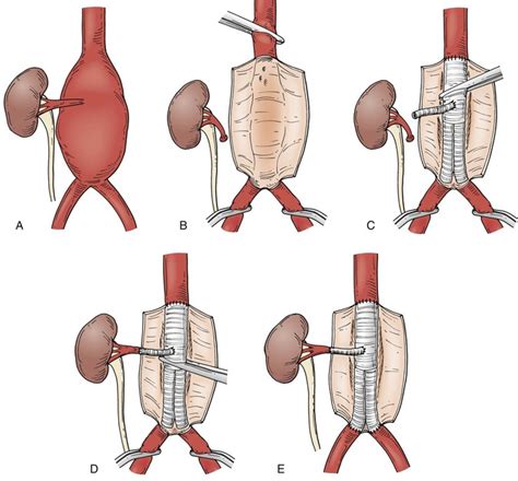 Suprarenal Abdominal Aortic Aneurysm