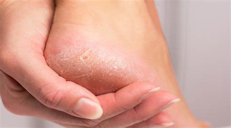 Causes & Treatment for Dry and Cracked Skin | Advanced Foot & Ankle