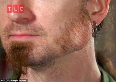 Man gets 'jaw-breaking' cyst removed in Dr Pimple Popper | Daily Mail ...