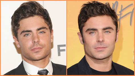 Here’s What Zac Efron Looked Like Before and After His Accident