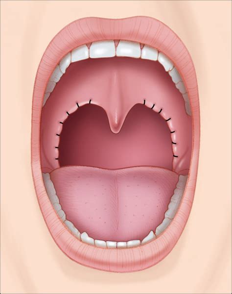 Tonsils Before And After