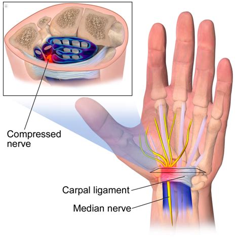 Median Nerve Palsy