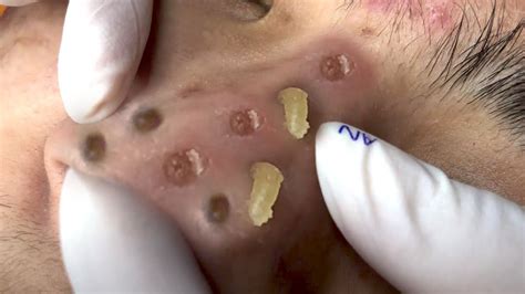 Clean Giant Blackheads on Nose - YouTube