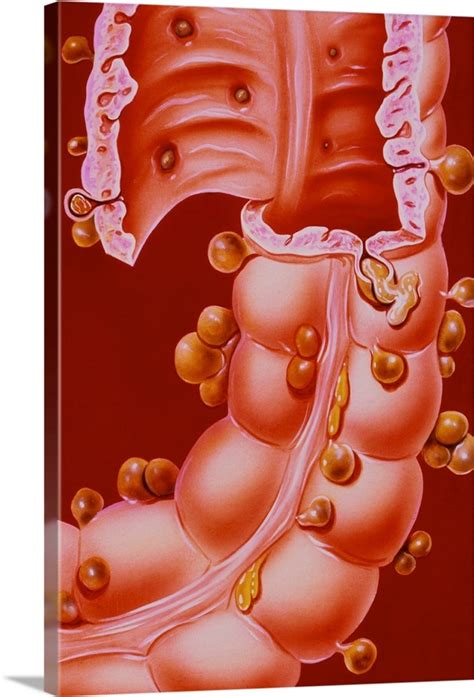 Illustration showing diverticulitis of the colon Wall Art, Canvas ...