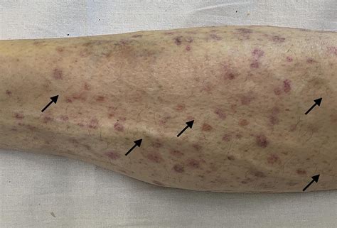 Ecchymosis Vs Petechiae