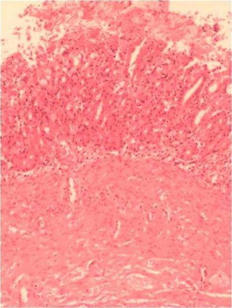 Pathology of the resected large-sized esophageal duplication cyst ...