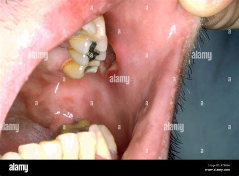 Mouth ulcers HIV Stock Photo - Alamy