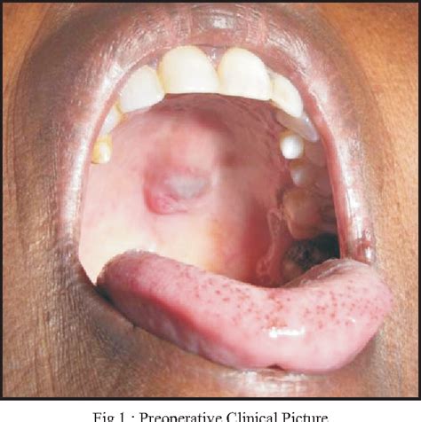 Figure 3 from Mucoepidermoid carcinoma of palate mimicking vascular ...