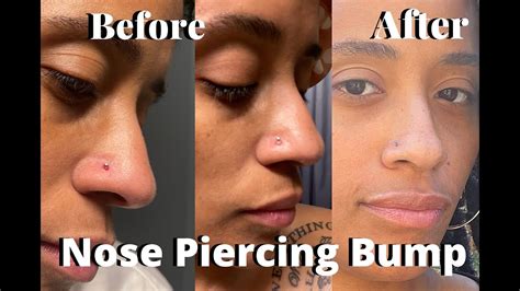 How to get rid of a nose piercing bump - My Journey - YouTube