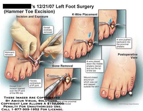 Hammer toe surgery - gulugod