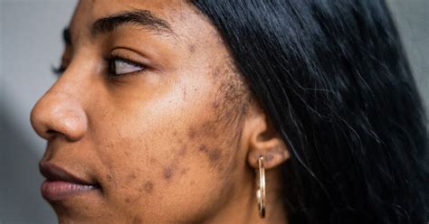 Types of Acne Scars: Pictures of Boxcar, Icepick, Rolling, and More