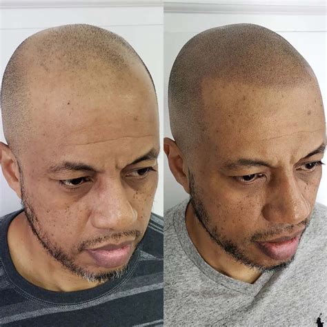 Hairline Tattoo - Cosmetic Tattoo for a Receding Hairline