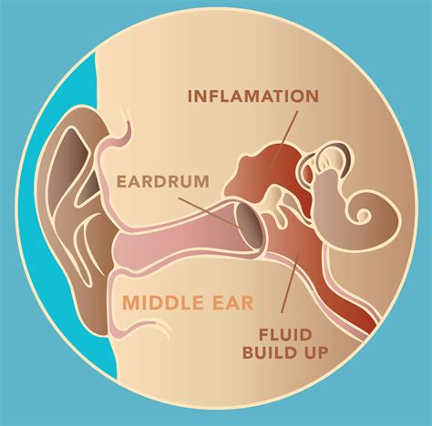 What a Middle Ear Infection Looks Like