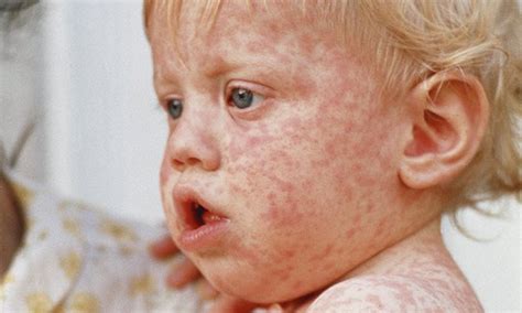 Measles rash