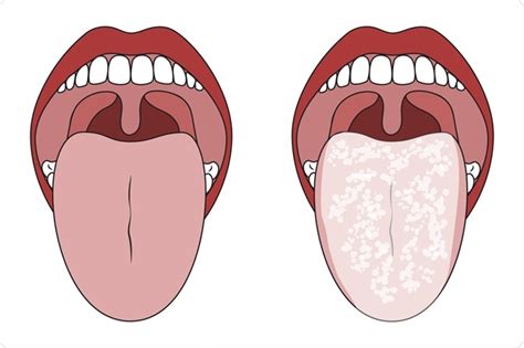 Oral Candidiasis Treatment