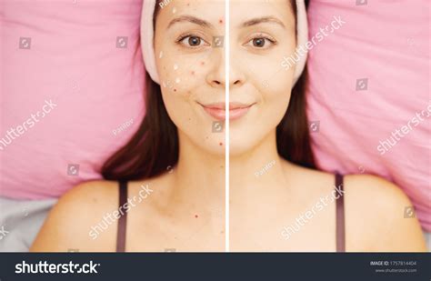 Before After Acne Treatment Procedure Woman Stock Photo 1757814404 ...