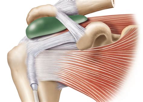 Subacromial Injection