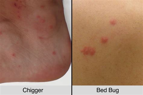 Flea Bites Vs Bed Bug Bites | Renew Physical Therapy