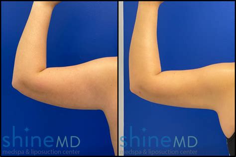 Patient Shine Md 3098550 Arm Lipo - Shine MD Medspa & Liposuction Center