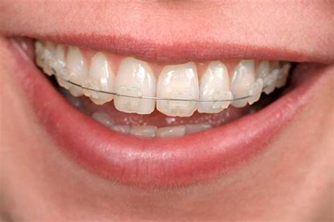 Clear Bracket Braces Before And After