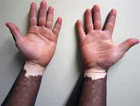 Vitiligo - Dermatology - Medbullets Step 1