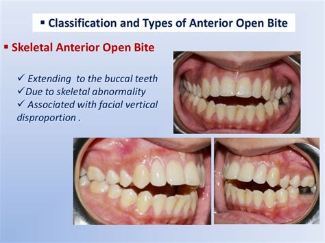 Anterior Open Bite etiology and differential diagnosis