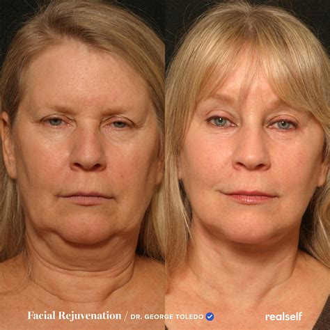 6 Treatments for Jowls