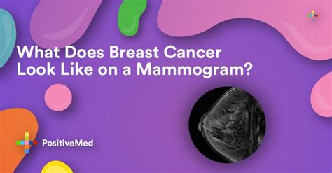 What Does Breast Cancer Look Like on a Mammogram? - PositiveMed