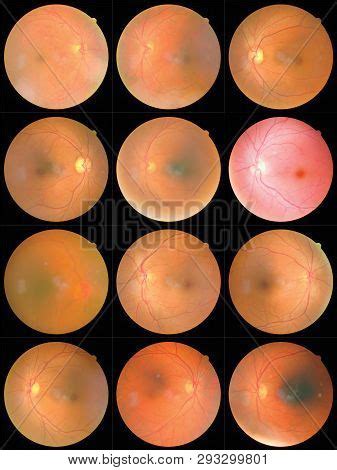 Collection Retinal Image & Photo (Free Trial) | Bigstock