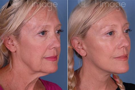 QT Lift in Atlanta, GA | Mini Facelift | Dr. Louis DeJoseph