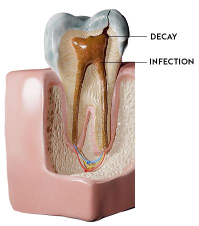 Root Canal Therapy | Turtle Creek Dental Associates