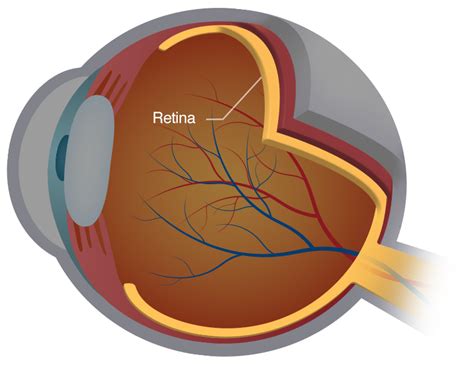 Retinal Diseases Blindness | Retina Associates Kansas City