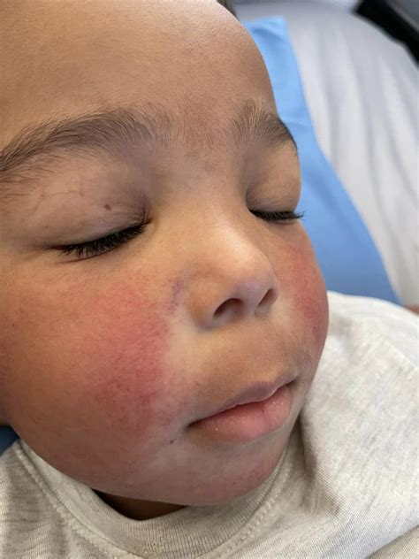 Kansas Boy, 3, With Red Cheeks Led to Leukemia Diagnosis