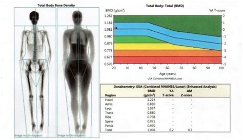 Dexa Scan | Bone Mineral Density Tool | ARC Recovery & Rehabilitation