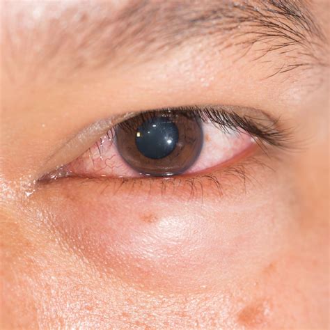 What Is Chemosis? | MyVision.org