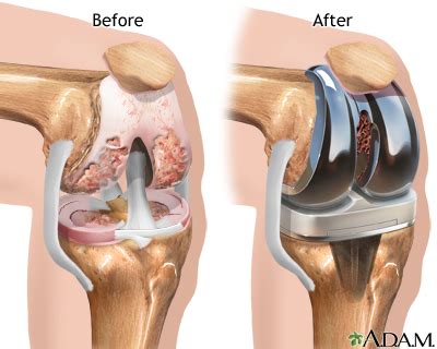 Different Types of Knee Replacement Implants