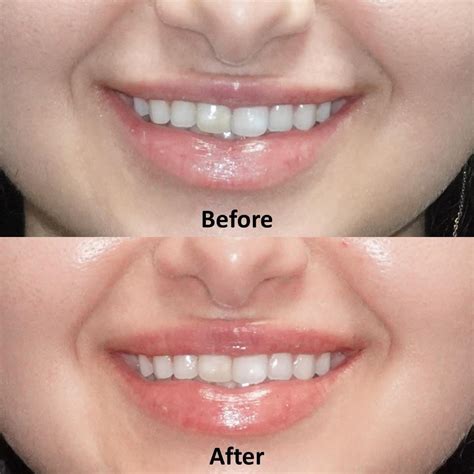 Lip Flip Botox Before And After Photos - Infoupdate.org