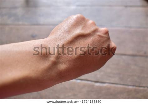 Prominent Dorsal Metacarpal Veins Left Hand Stock Photo 1724135860 ...