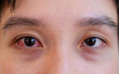 Sore Eyes Causes and Treatment : What You Can Do